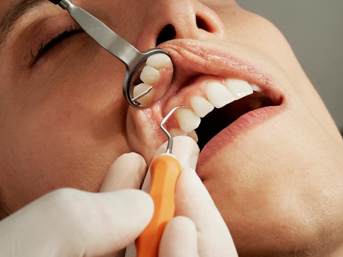 Odontólogo revisando los dientes de un paciente con espejo y explorador