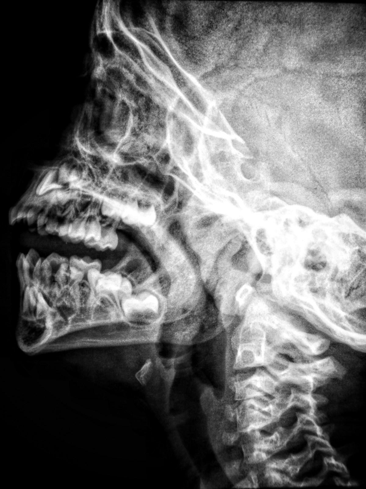 Radiografía lateral de cráneo y cara
