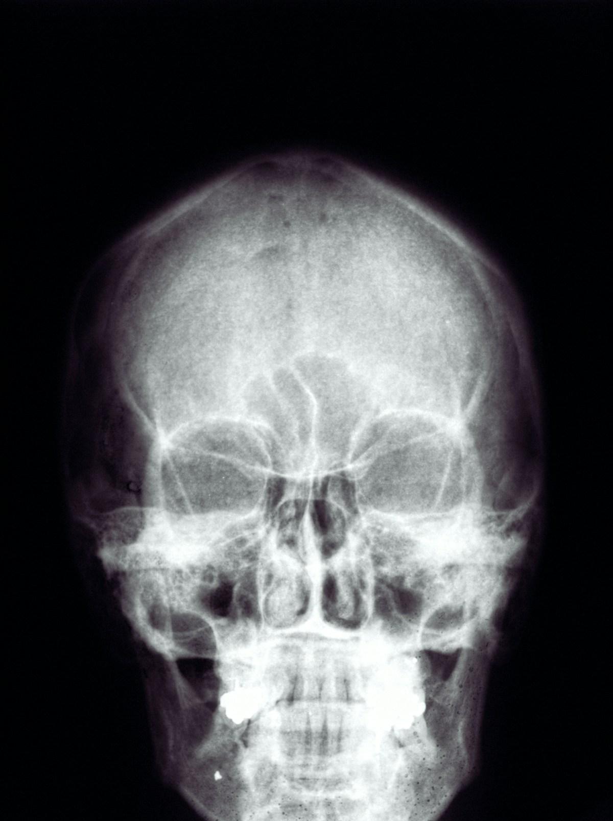 Radiografía frontal de cráneo sobre fondo negro