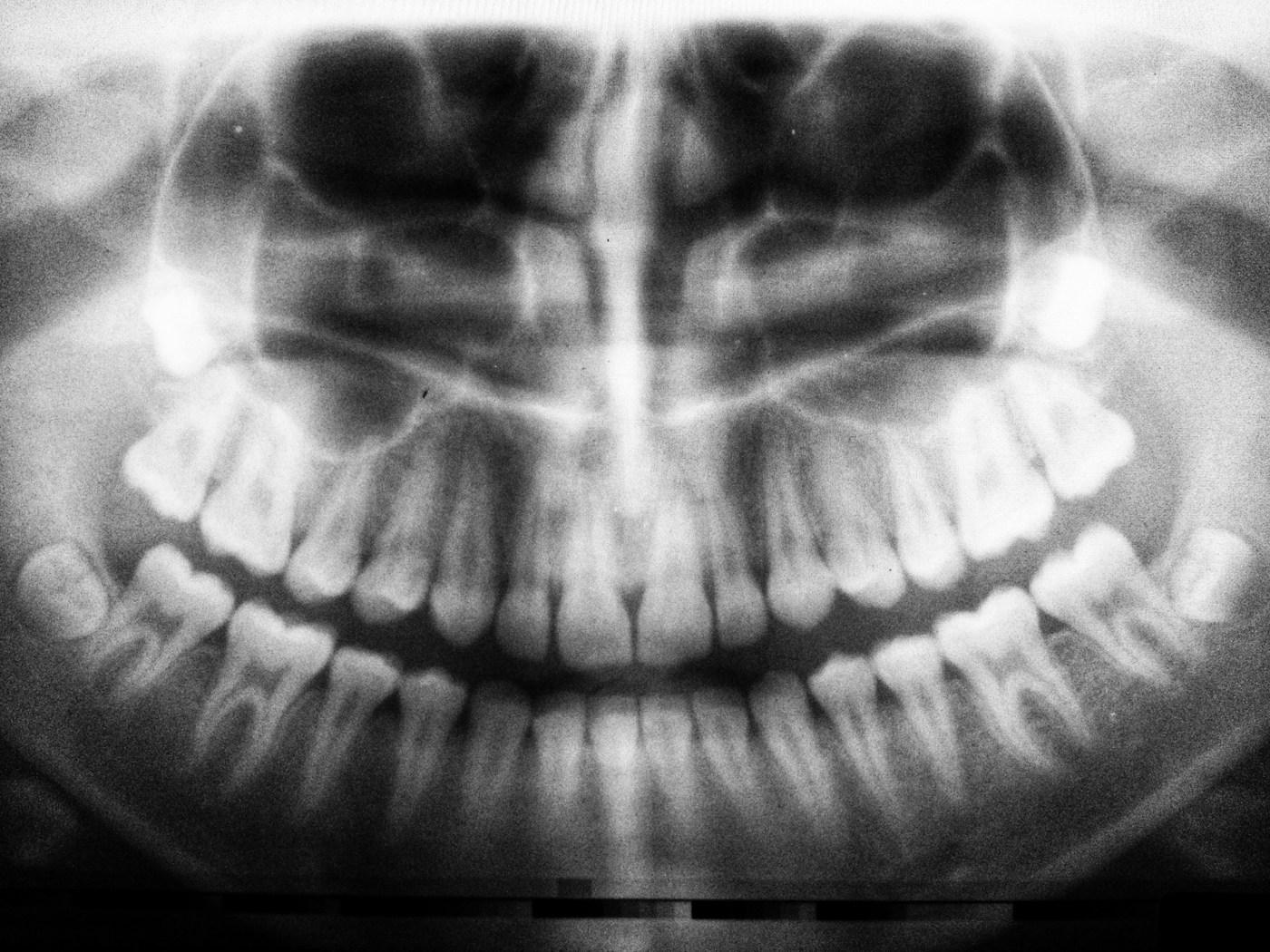 Radiografía de cerca de varios dientes y sus raíces