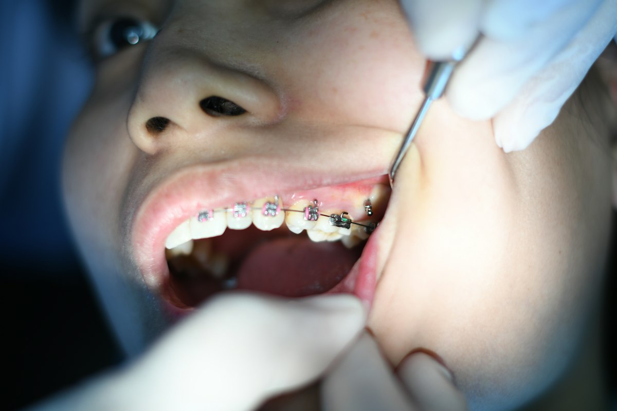Control de brackets durante una consulta