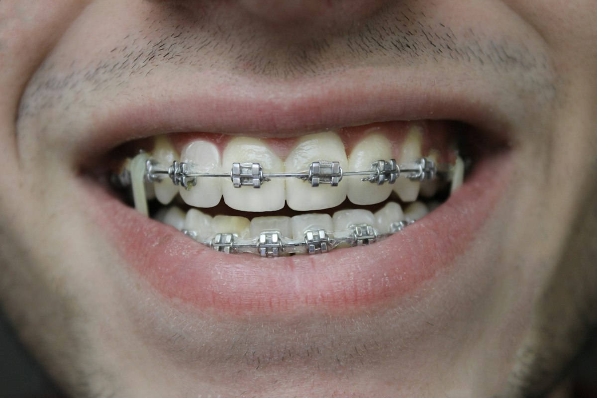 Sonrisa con brackets metálicos