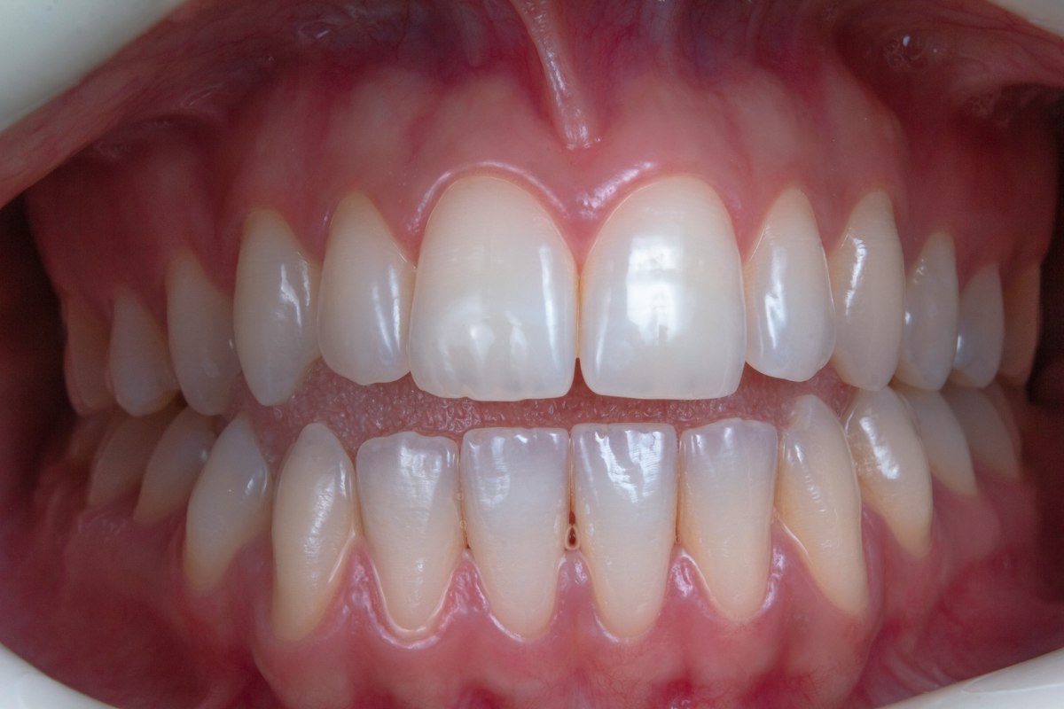 Primer plano de dientes y encías sanos con una mordida pareja